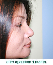 plastic_surgery_augmentation_rhinoplasty